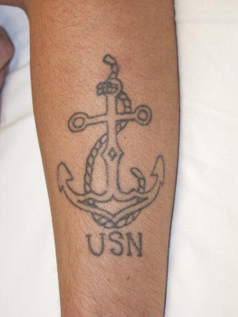 Tattoo Removal