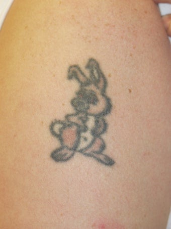 Laser Tattoo Removal