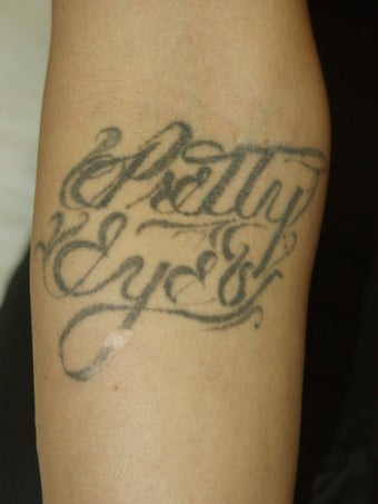 Tattoo Removal
