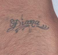 Los Angeles Tattoo Removal