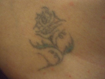 Tattoo Removal