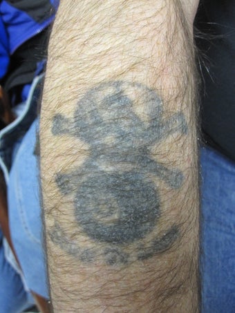5/10 Laser Tattoo Removal Treatments- Black Tattoo