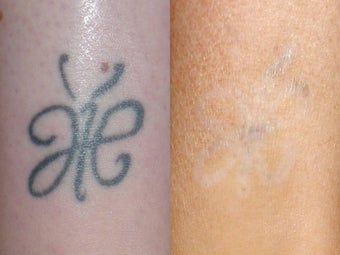 Laser Tattoo Removal