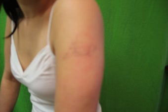 Laser Tattoo Removal