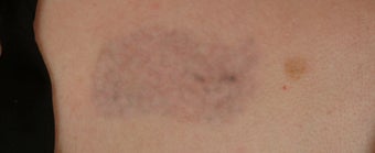 QSR Ruby Laser Tattoo Removal