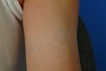 QSR Ruby Laser Tattoo Removal