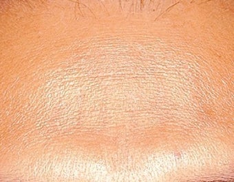 Laser tattoo removal