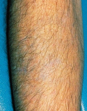 Laser tattoo removal 