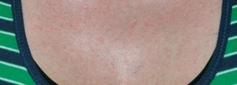 Laser tattoo removal