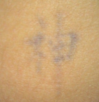 Laser tattoo removal 