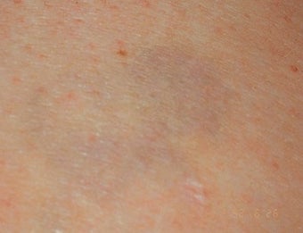 Laser tattoo removal 
