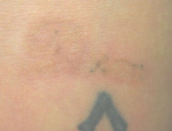 Laser tattoo removal