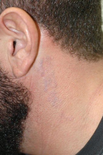 Tattoo Removal Before and After Pictures