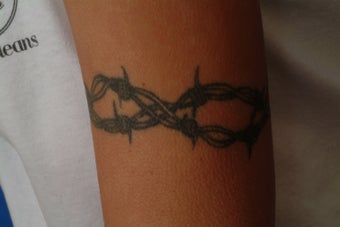 QSR Ruby Laser Tattoo Removal