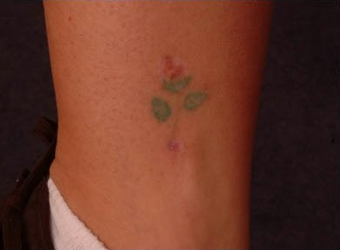 QSR Ruby Laser Tattoo Removal