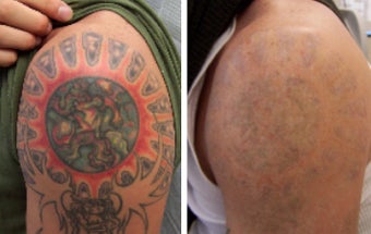Laser tattoo removal