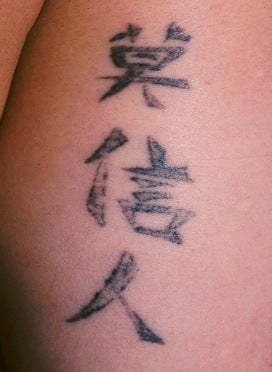 Laser tattoo removal
