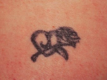 Laser tattoo removal 