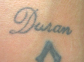 Laser tattoo removal