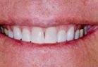 Kor Deep Bleaching Tooth Whitening System