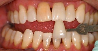 Deep bleaching
