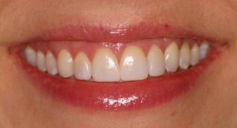 Deep bleaching and porcelain veneers