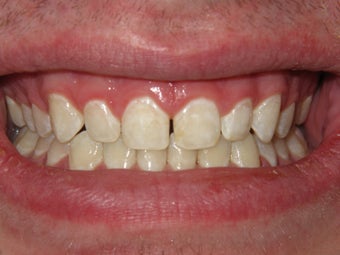 ICON- White Spot Treatment