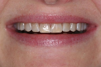 Composite veneers along with whitening