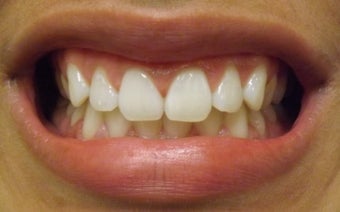 Zoom Teeth Whitening Before and After Photos