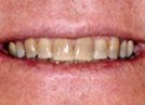 Kor Deep Bleaching Tooth Whitening System