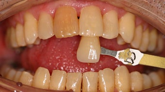 Deep bleaching