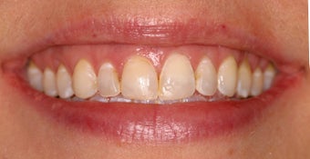 Deep bleaching and porcelain veneers