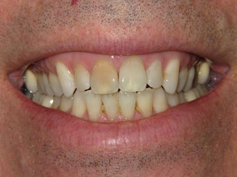 Whitening with walking bleach