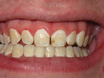 ICON- White Spot Treatment
