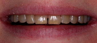 Composite veneers along with whitening