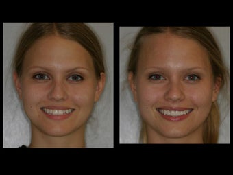 Smile Makeover with Veneers and Teeth Whitening