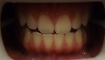 Zoom Teeth Whitening Before and After Photos