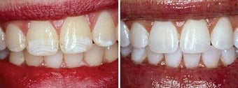 Teeth Whitening with Opalescence
