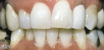 Teeth Whitening Smoking
