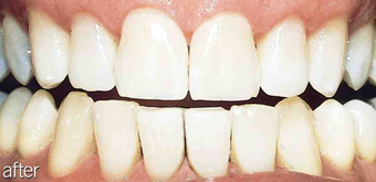 Whitening aging teeth