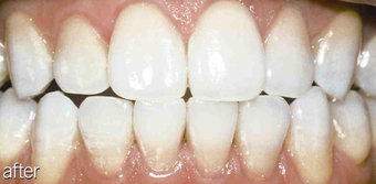 Tetracycline 