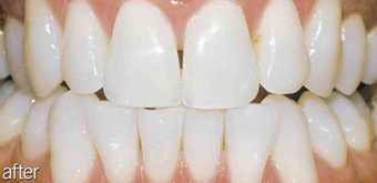 Teeth whitening genetic