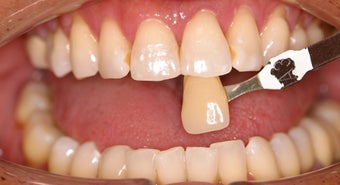 Deep bleaching