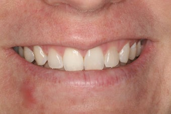 Whitening a single anterior tooth