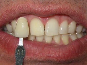Whitening bleach trays