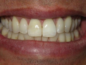 Internal Deep Bleaching