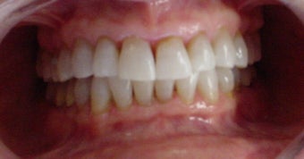 whitening tetracycline stained teeth