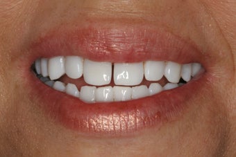 KOR Whitening