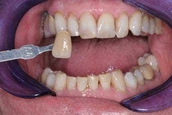 Whitening