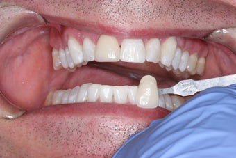 Whitening